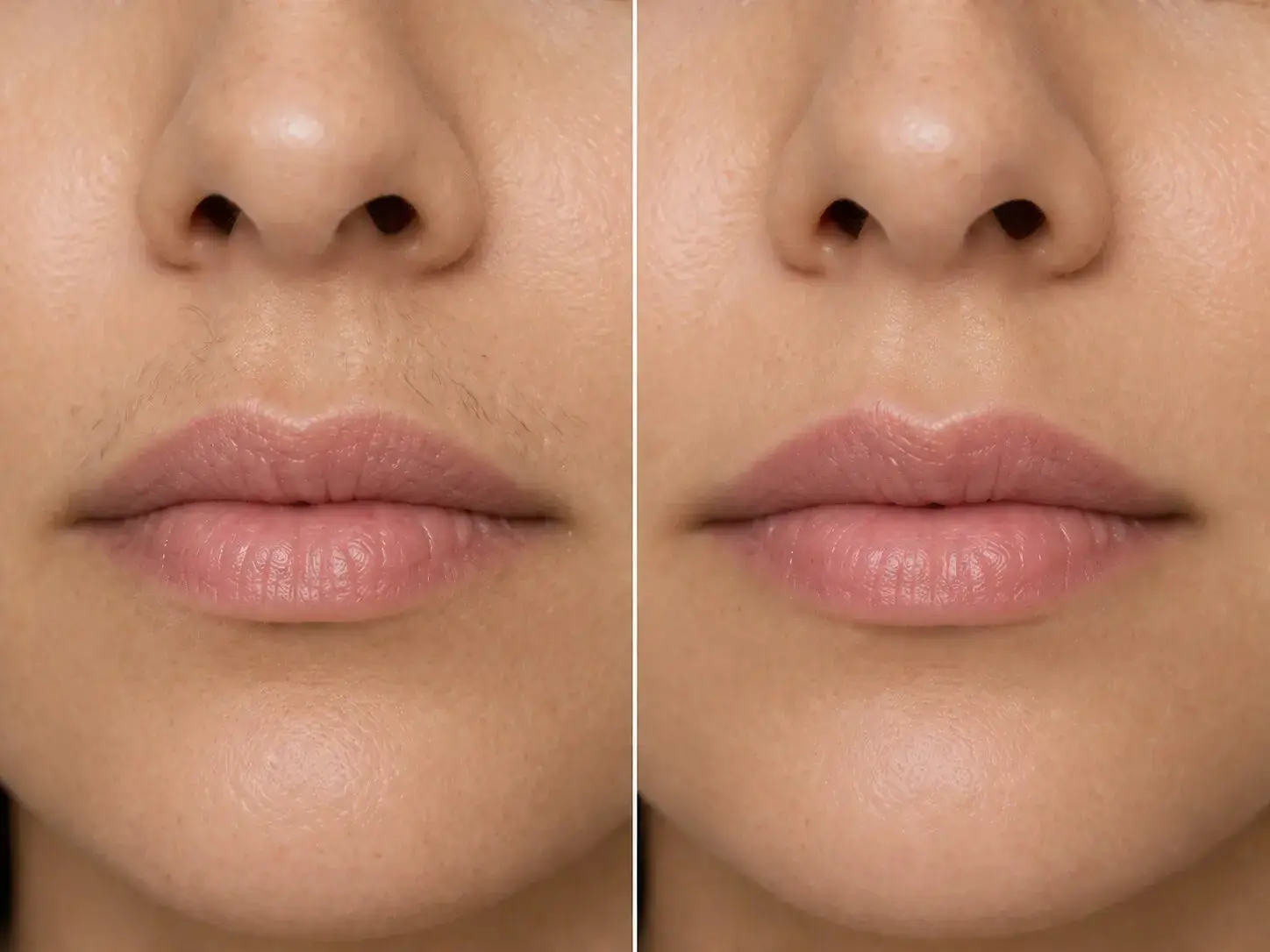 Upper lip hair before and after depilation